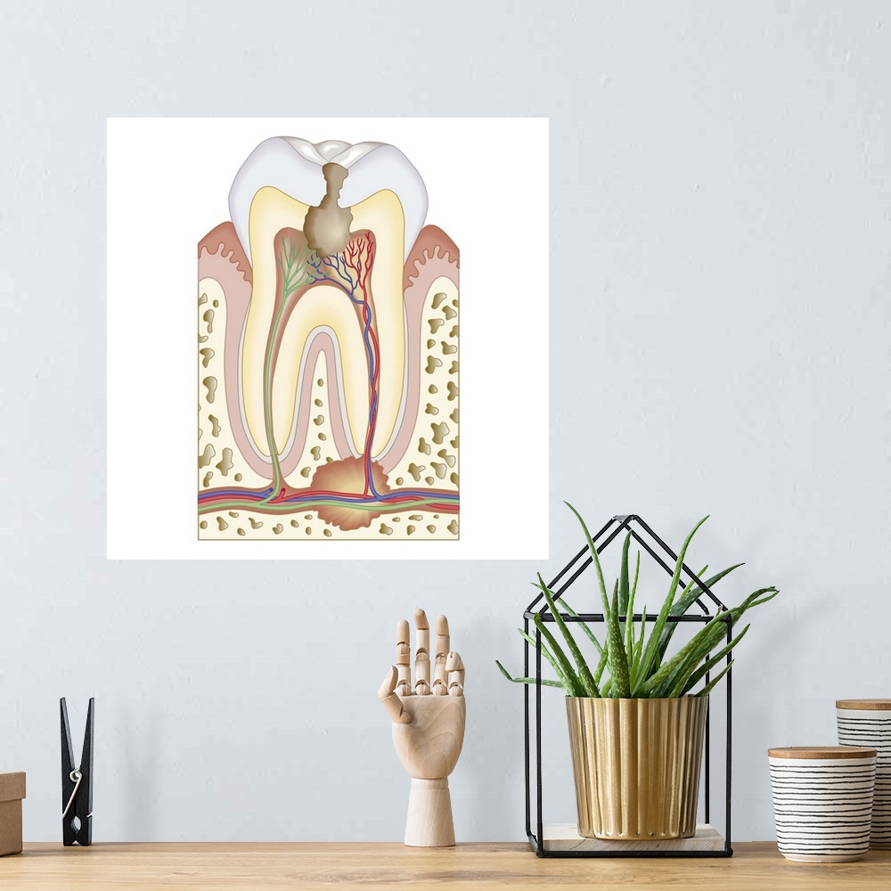 A bohemian room featuring Cross section biomedical illustration of pulp and root abscess in molar