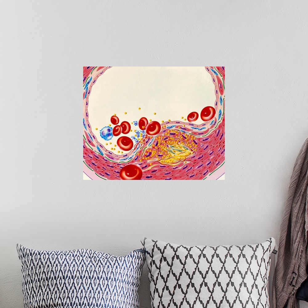 A bohemian room featuring Atherosclerosis. Illustration of a cross-section through an artery narrowed by atherosclerosis. F...
