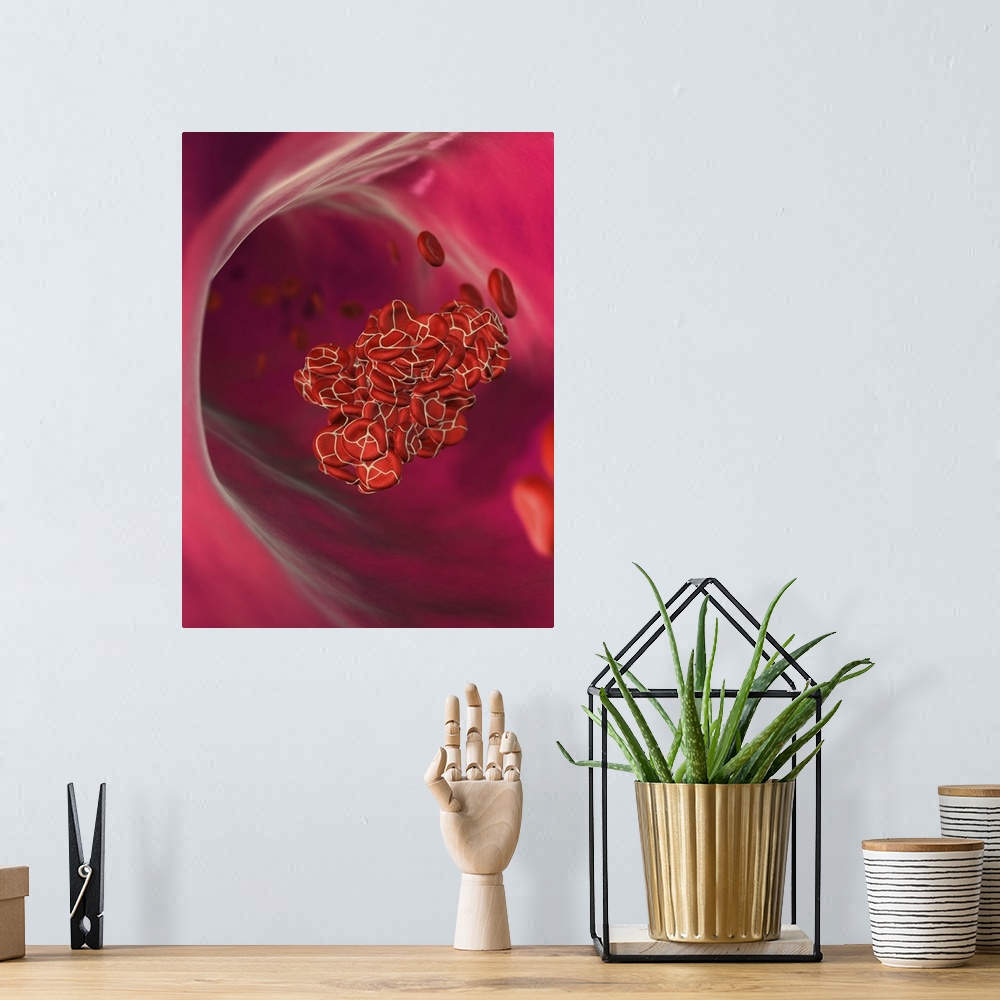 A bohemian room featuring Detached blood clot. Computer artwork of an embolus (detached blood clot) in a blood vessel. The ...