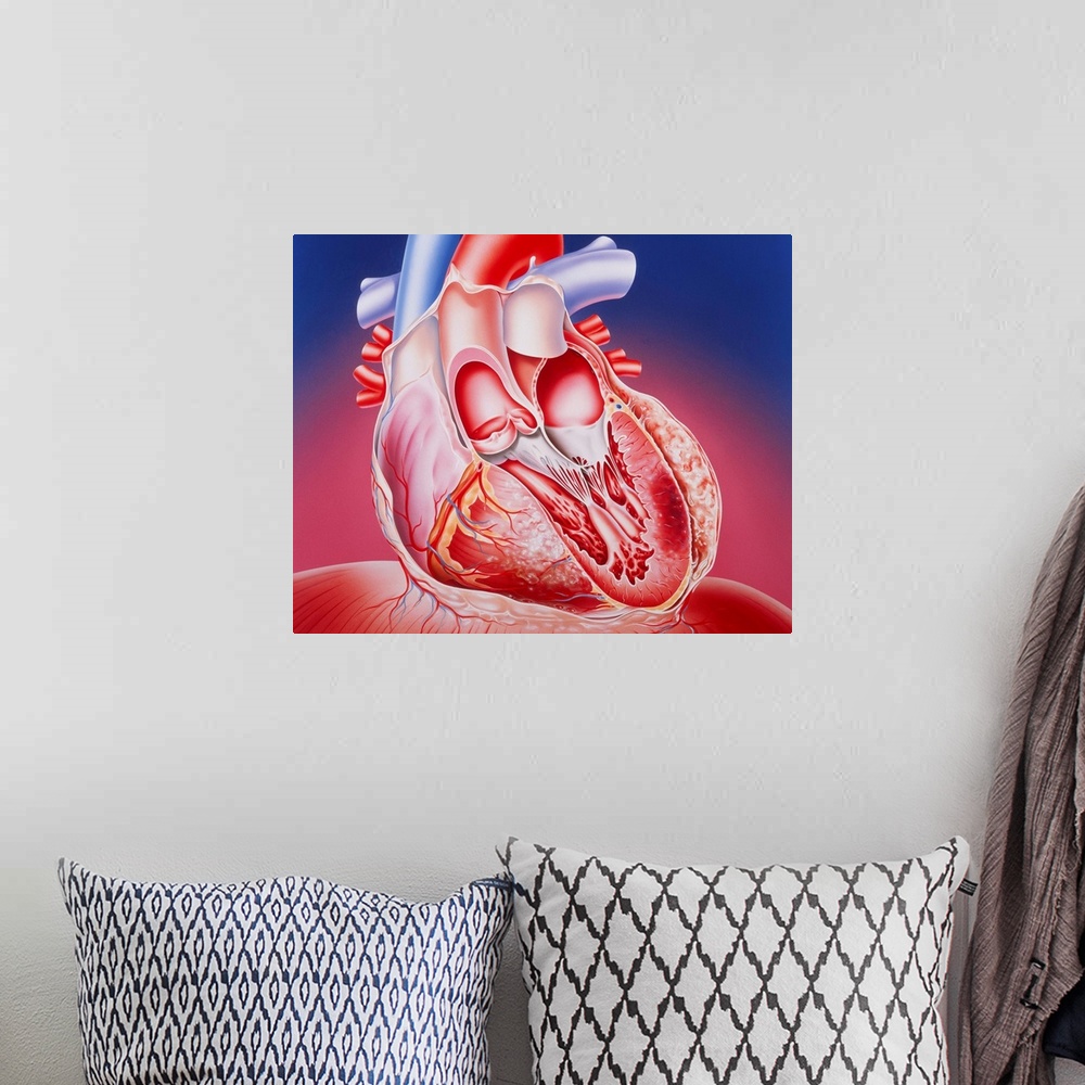 A bohemian room featuring Post-infarction heart. Illustration of a partly dissected human heart showing muscle damage cause...
