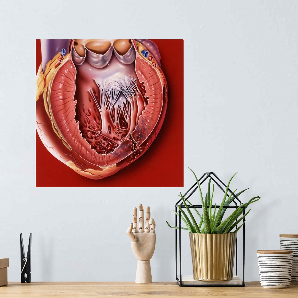 A bohemian room featuring Heart disease. Computer artwork of a sectioned heart showing a myocardial rupture (bottom right) ...