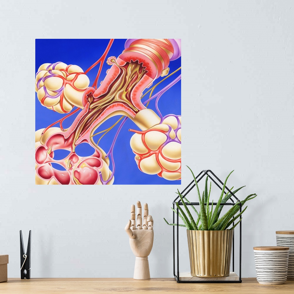 A bohemian room featuring Chronic obstructive pulmonary disease. Artwork of a bronchus and alveoli of the lungs in chronic ...