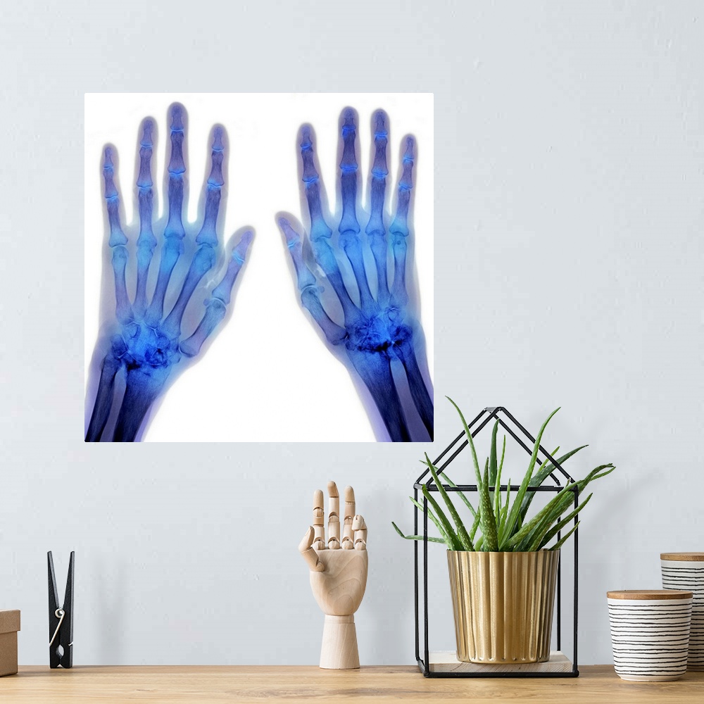 A bohemian room featuring Coloured X-ray (top view) of the hands of a patient, showing rheumatoid arthritis affecting some ...
