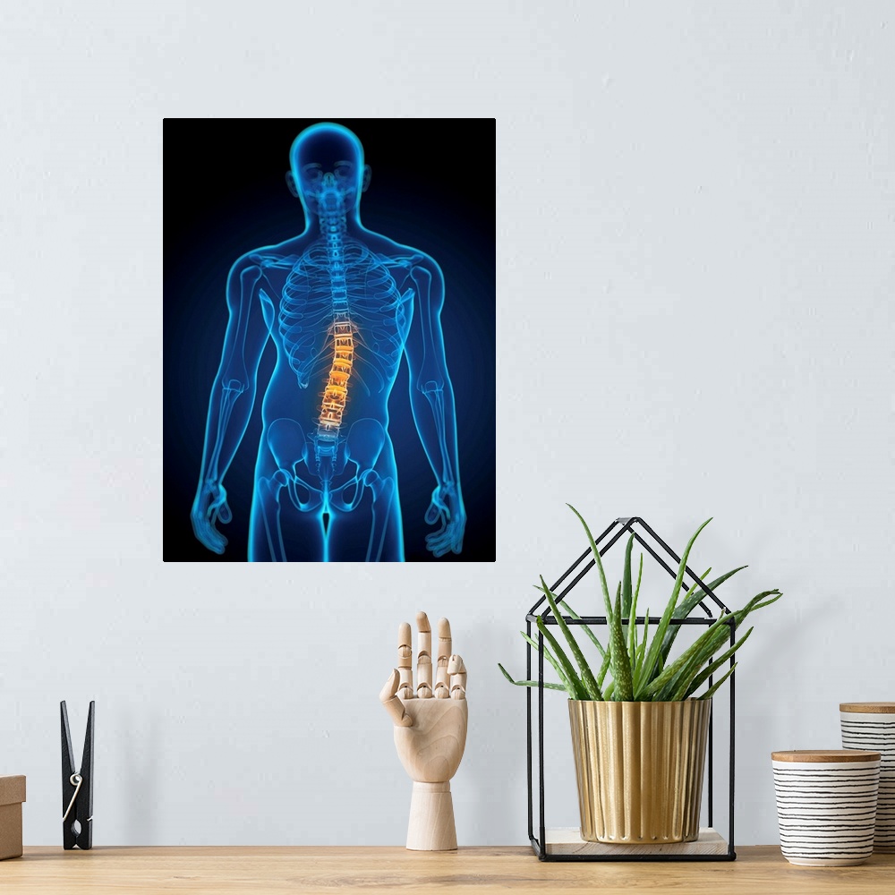 A bohemian room featuring Scoliosis. Computer artwork of a man with a sideways curvature (scoliosis) of the spine.