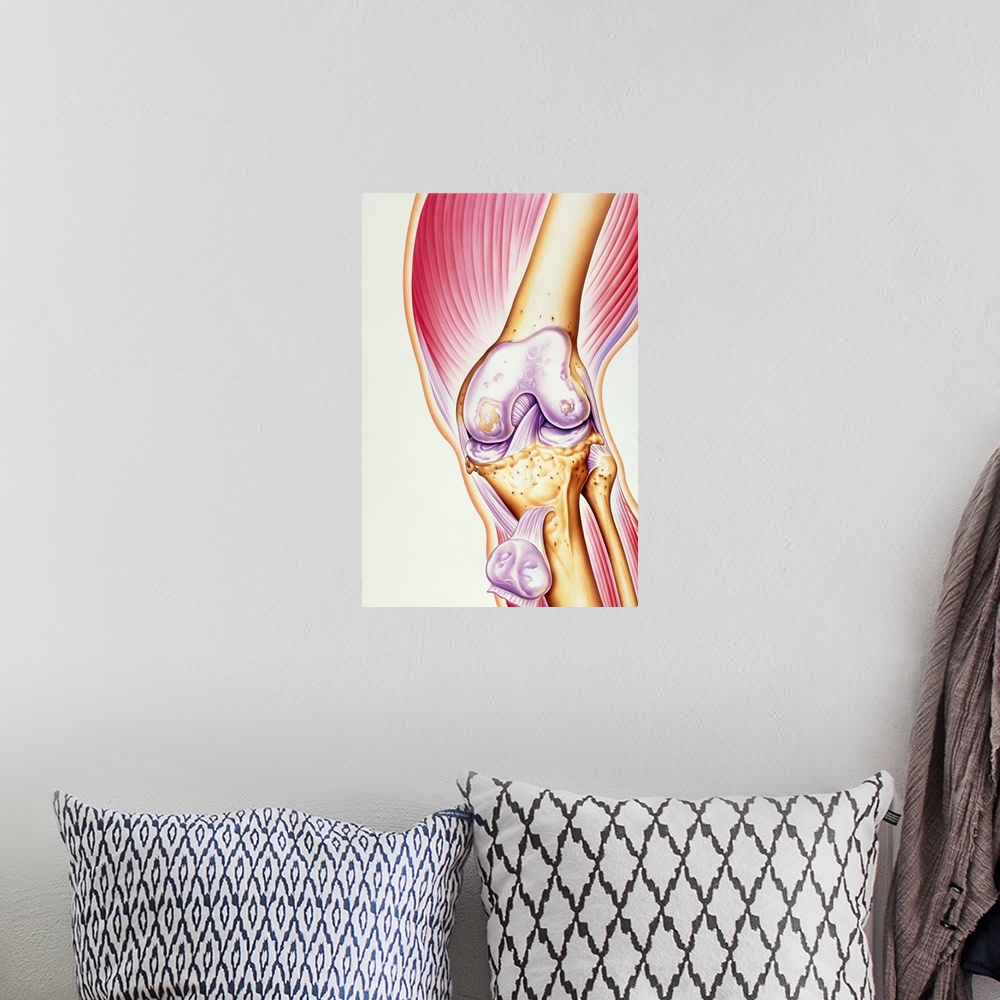A bohemian room featuring Osteoarthritis of knee. Illustration of the joint of a human knee affected by osteoarthritis. The...