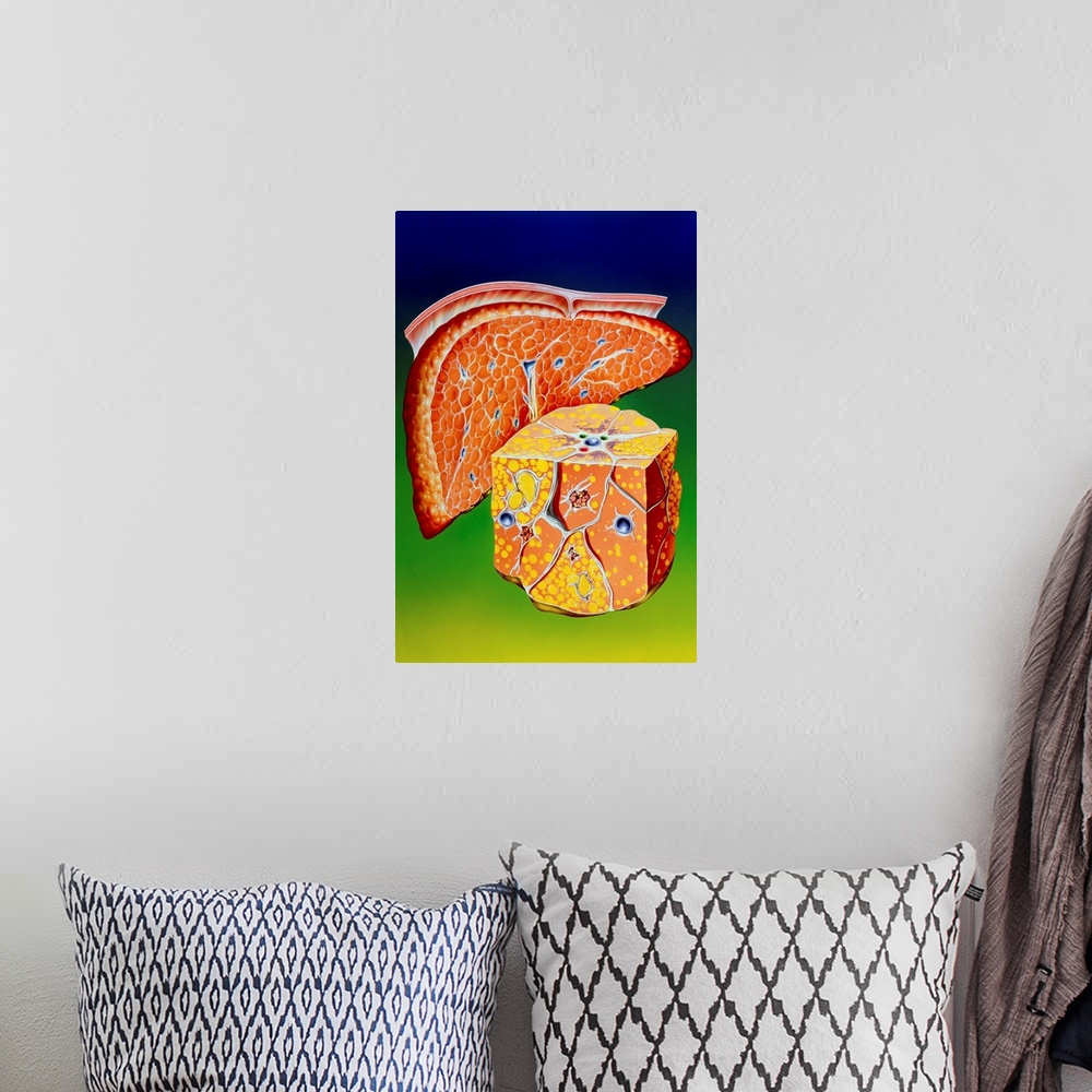 A bohemian room featuring Illustration of septal cirrhosis of the liver. Cirrhosis is a liver disease resulting in chronic ...