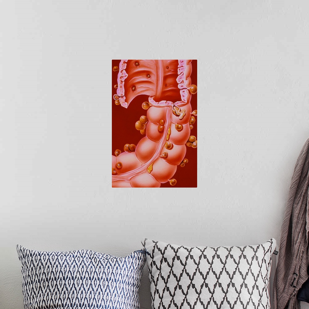 A bohemian room featuring Diverticulitis. Illustration of a region of the descending colon of the human intestine, showing ...