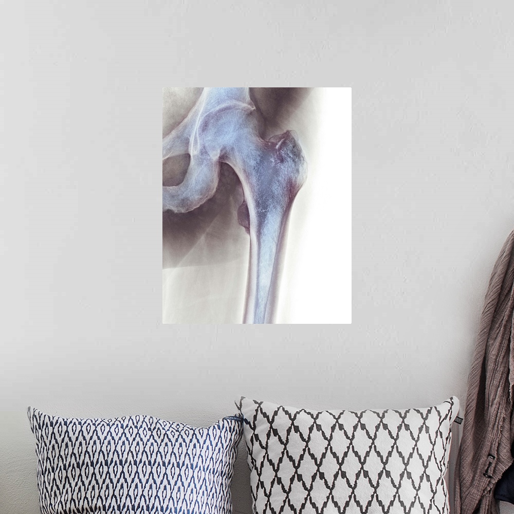 A bohemian room featuring Normal hip. Coloured X-ray of the hip of a 90 year old man.