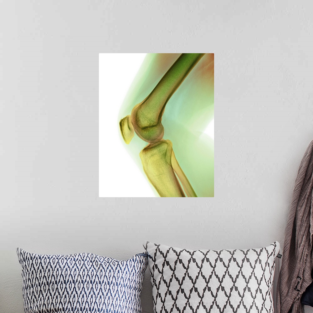 A bohemian room featuring Normal knee. Coloured X-ray of the knee of a 44 year old woman.