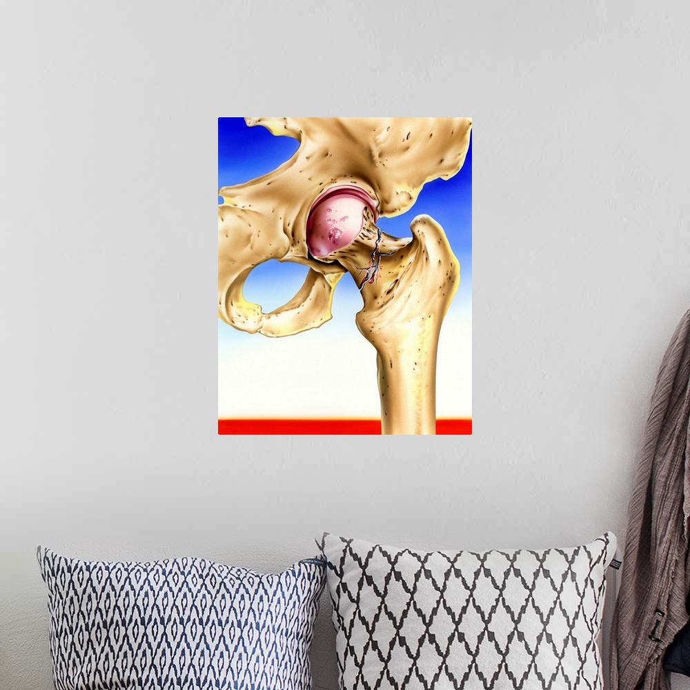A bohemian room featuring Osteoporosis. Artwork of a hip joint where the neck of the femur (thigh bone) has fractured due t...