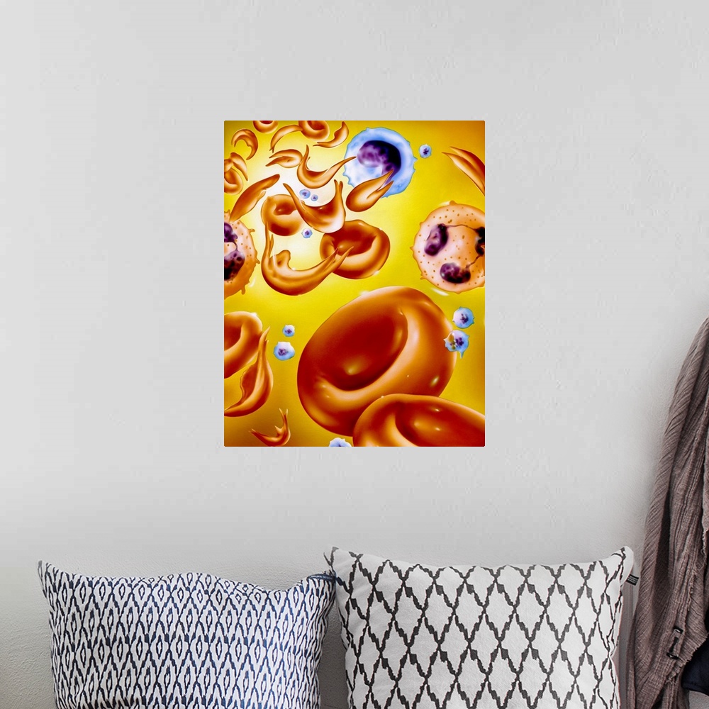 A bohemian room featuring Sickle cell anaemia. Artwork of red blood cells in sickle cell anaemia (drepanocytosis). The sick...