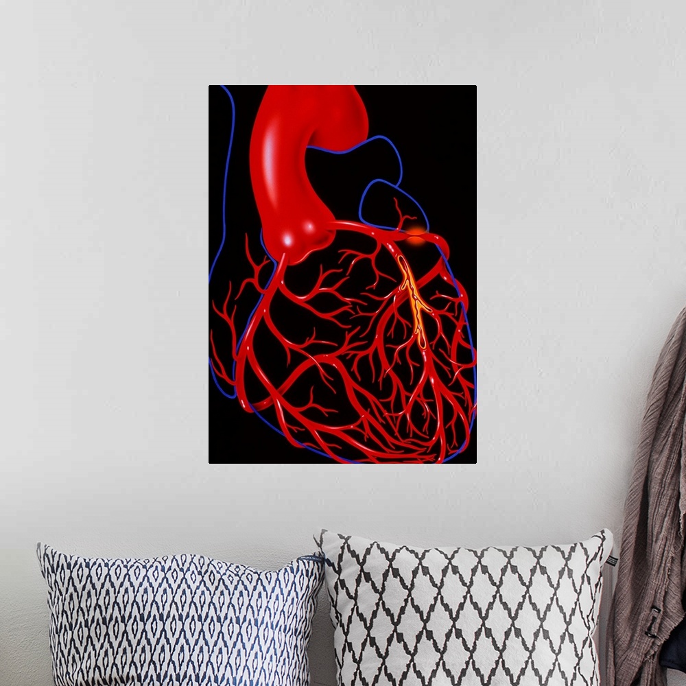 A bohemian room featuring Angina pectoris. Illustration of a heart diseased with the cardiac condition angina pectoris. The...
