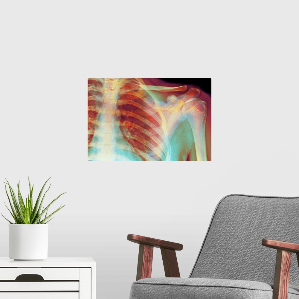 A modern room featuring Normal shoulder. Coloured X-ray of the shoulder of a 19 year old man.