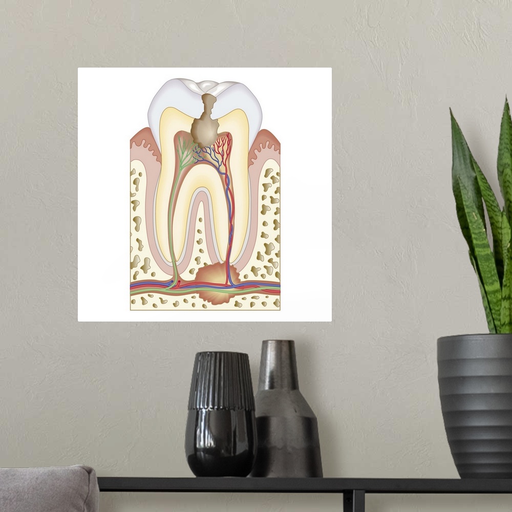 A modern room featuring Cross section biomedical illustration of pulp and root abscess in molar