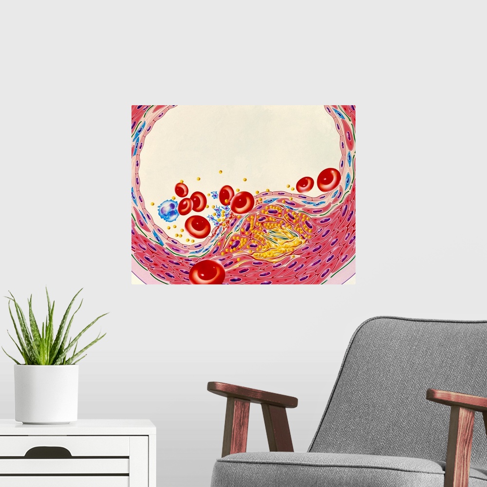 A modern room featuring Atherosclerosis. Illustration of a cross-section through an artery narrowed by atherosclerosis. F...