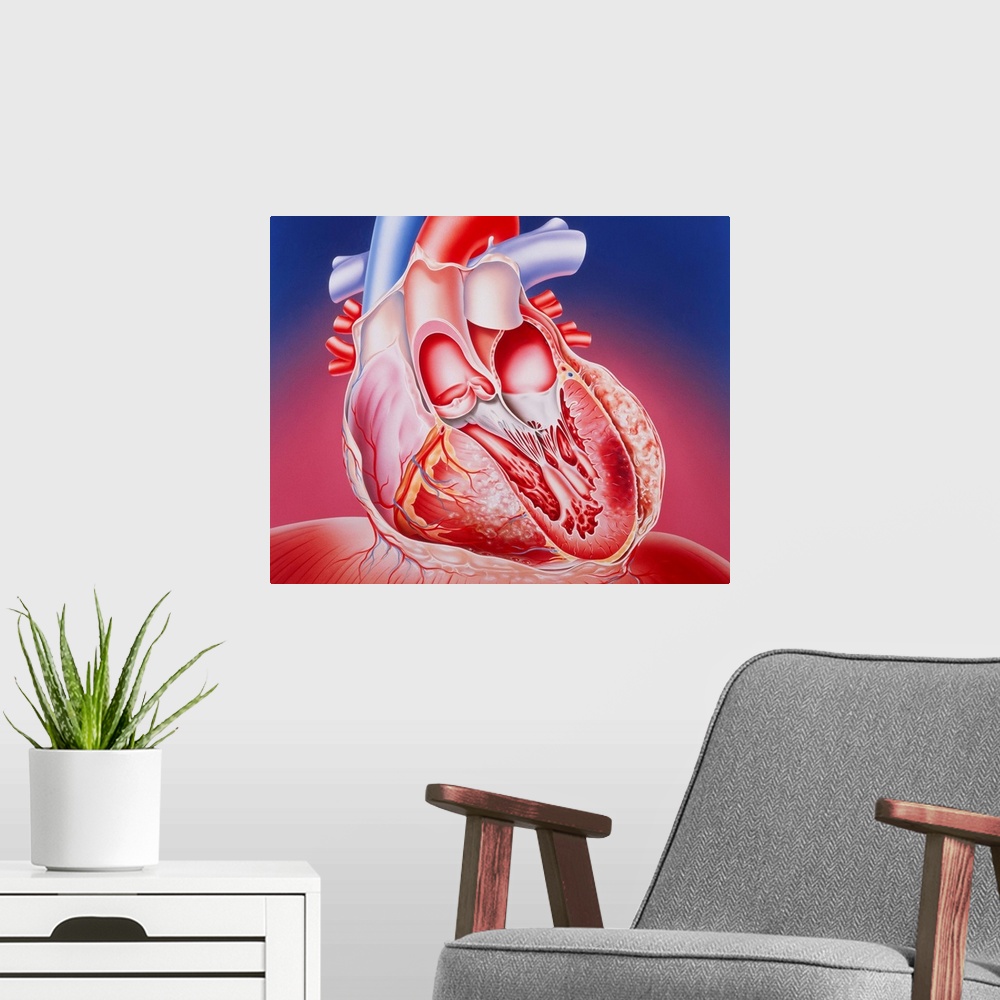 A modern room featuring Post-infarction heart. Illustration of a partly dissected human heart showing muscle damage cause...