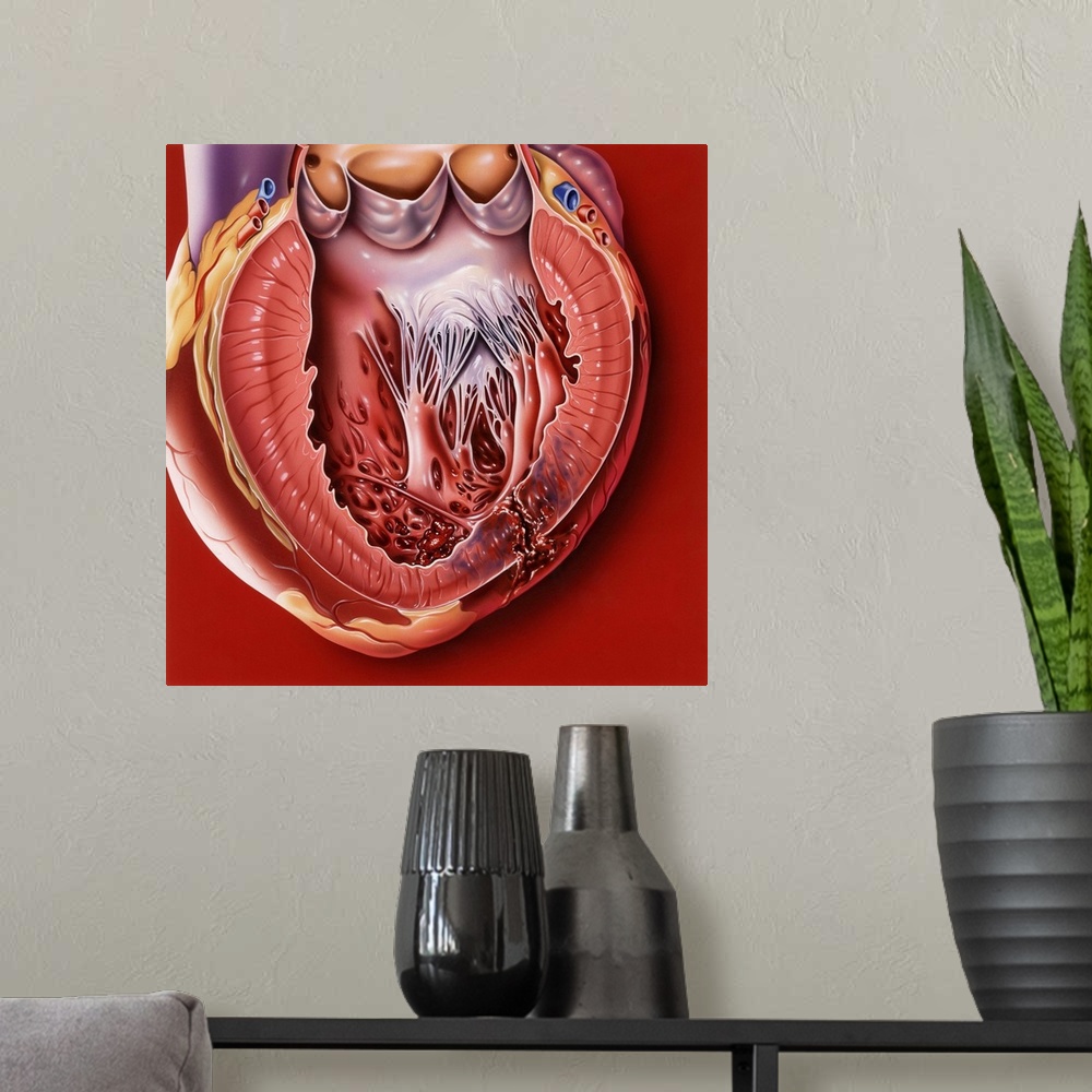 A modern room featuring Heart disease. Computer artwork of a sectioned heart showing a myocardial rupture (bottom right) ...
