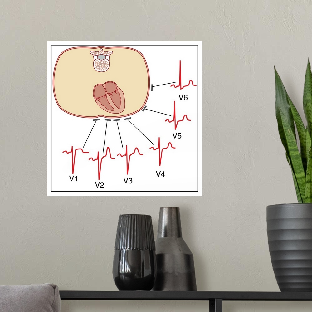 A modern room featuring Placing of electrodes for electrocardiogram (ECG), artwork. This diagram shows where the six elec...
