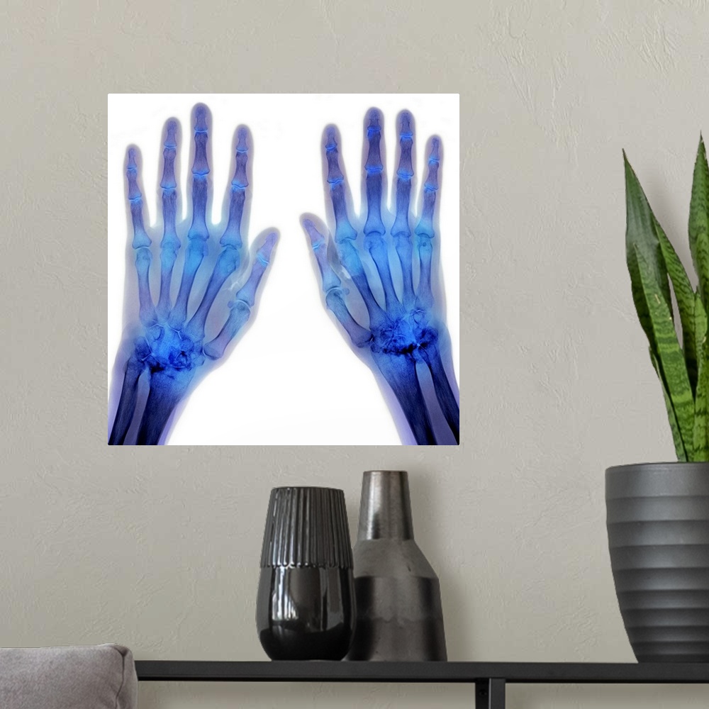 A modern room featuring Coloured X-ray (top view) of the hands of a patient, showing rheumatoid arthritis affecting some ...