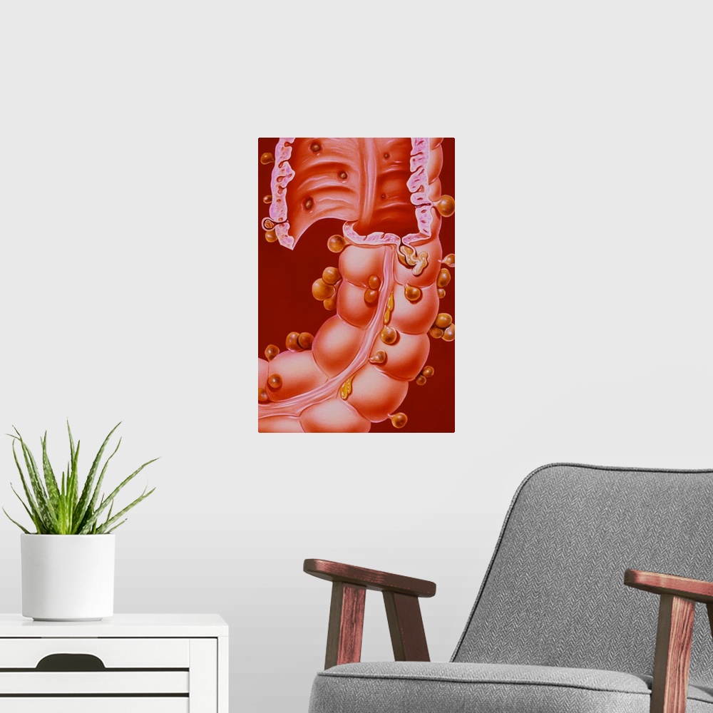 A modern room featuring Diverticulitis. Illustration of a region of the descending colon of the human intestine, showing ...