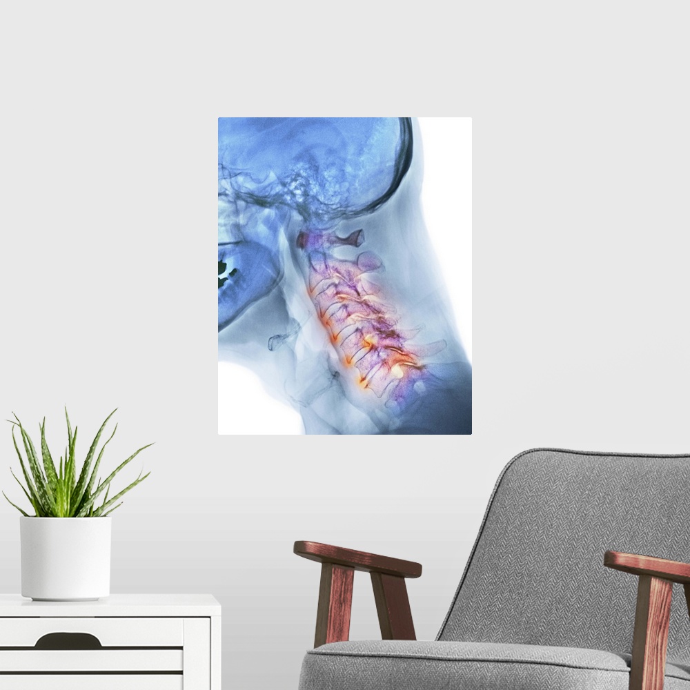 A modern room featuring Arthritis of the neck. Coloured X-ray of the arthritic cervical spine of a 70 year old man.