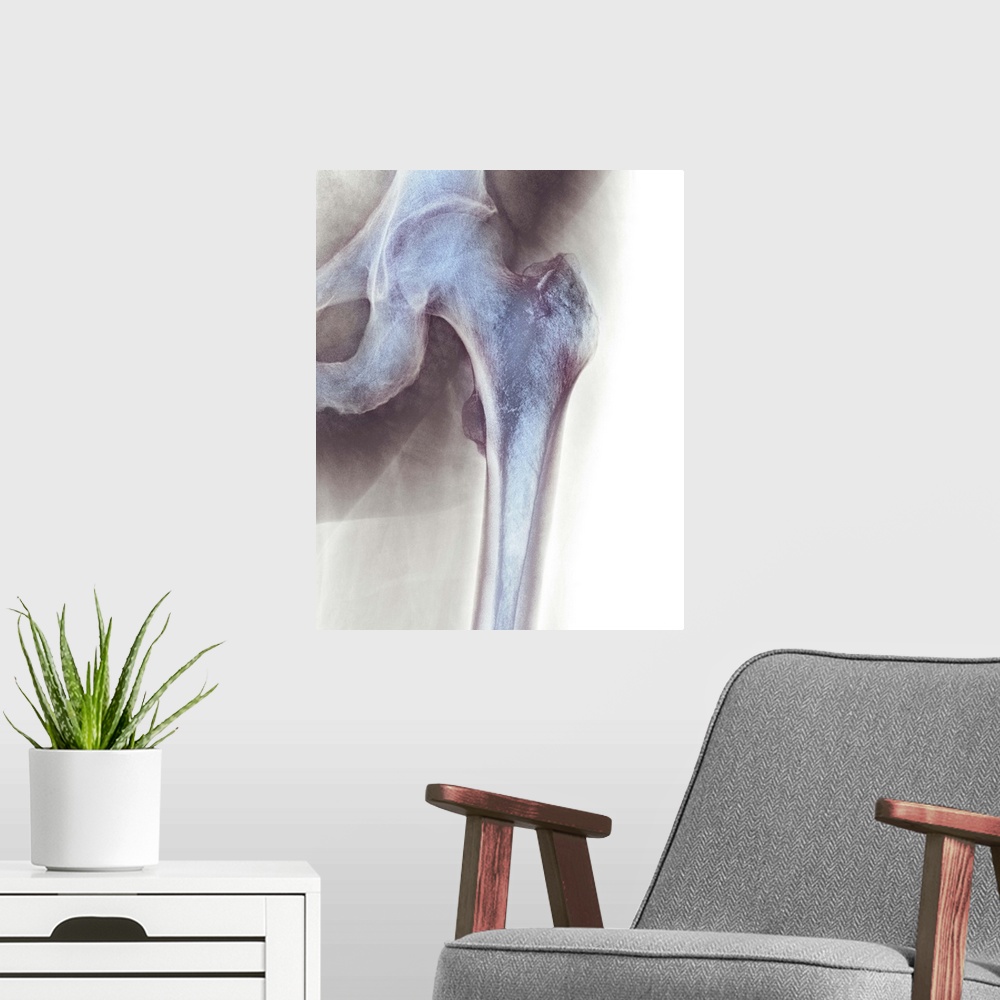A modern room featuring Normal hip. Coloured X-ray of the hip of a 90 year old man.