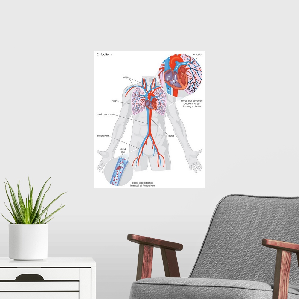 A modern room featuring Arterial embolism