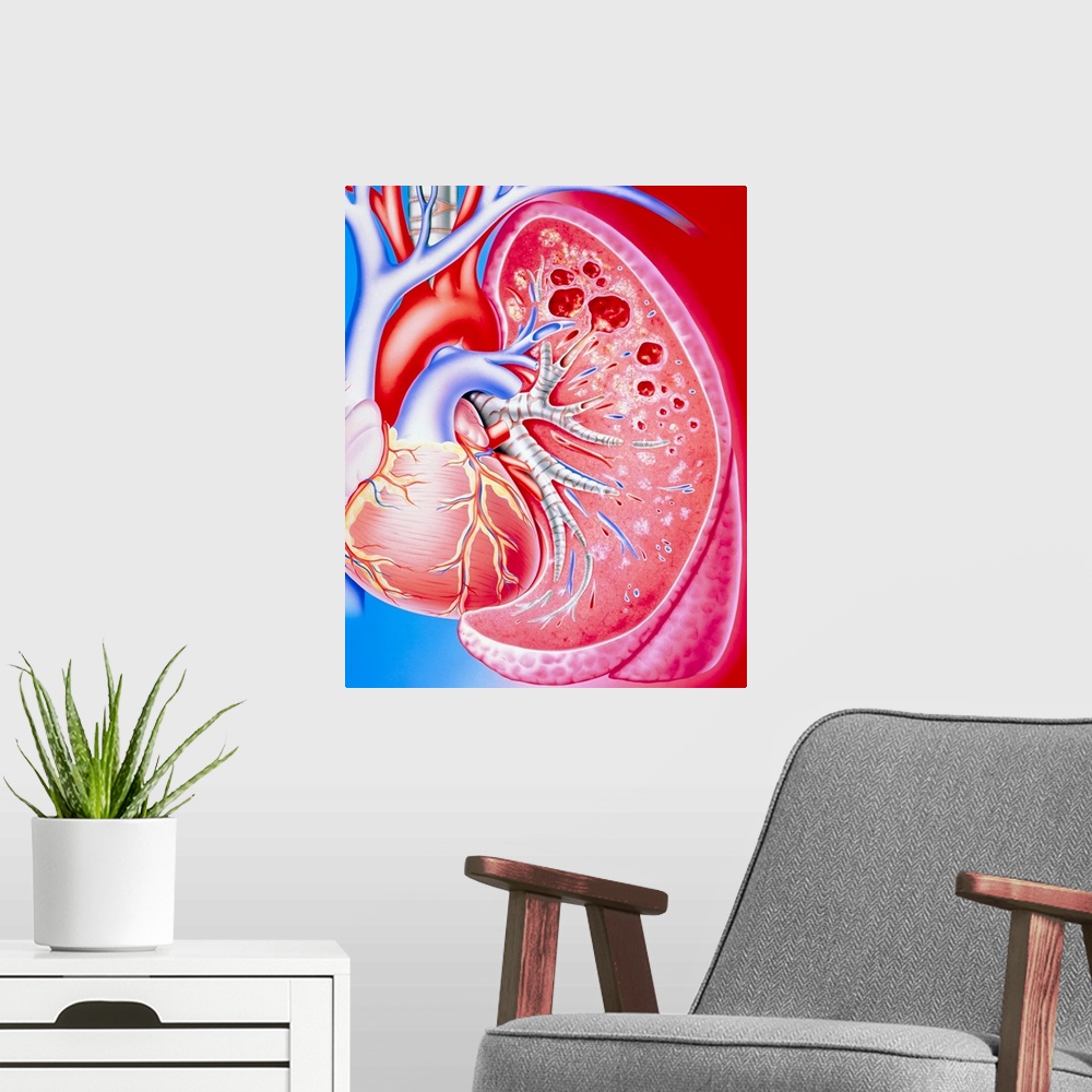 A modern room featuring Pulmonary tuberculosis. Illustration of a human lung diseased with pulmonary tuberculosis. At cen...