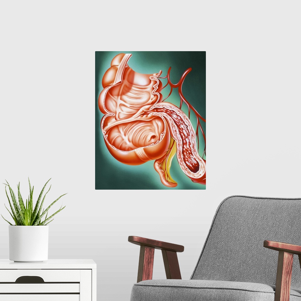 A modern room featuring Crohn's disease. Artwork of a section through part of the human digestive tract, showing the smal...