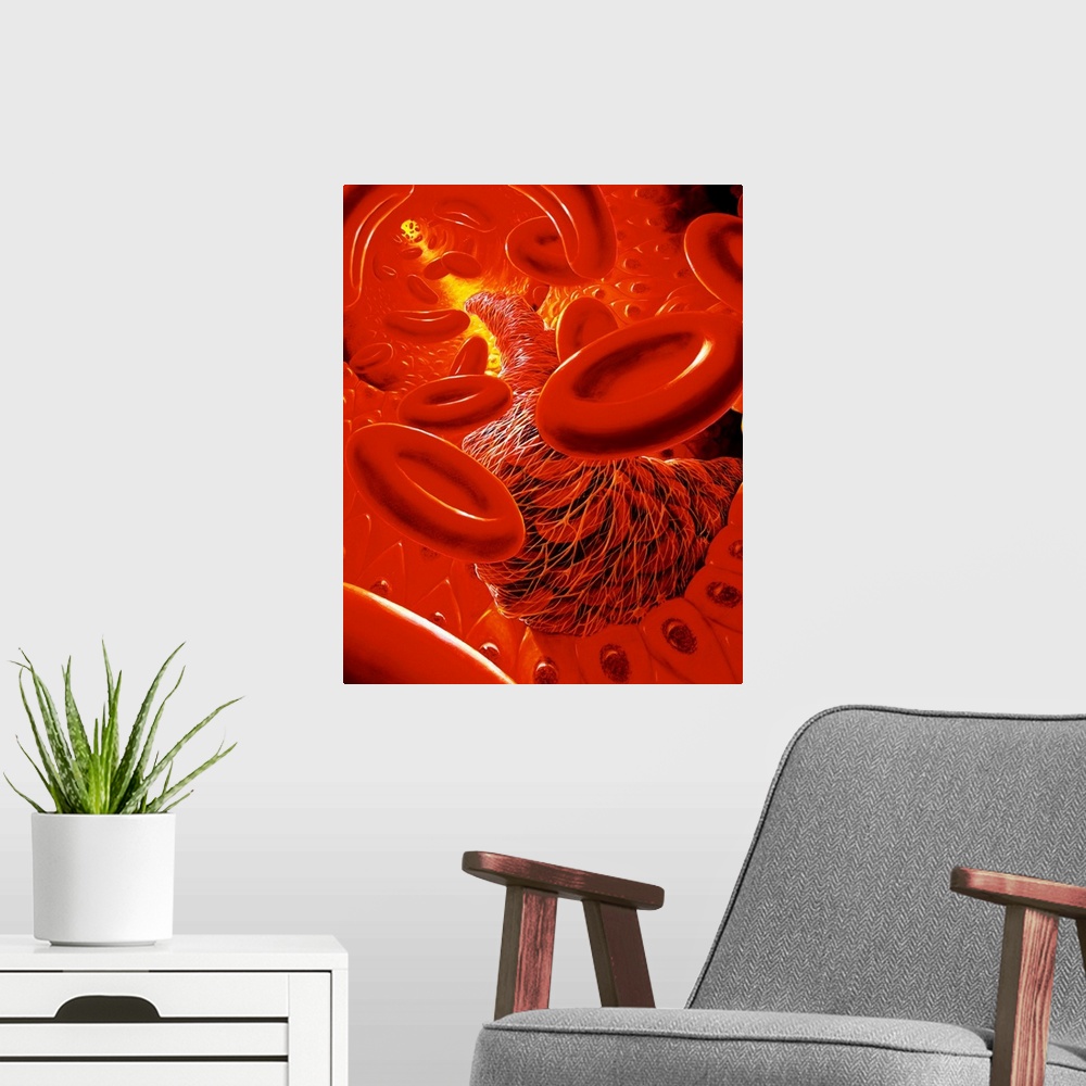 A modern room featuring Illustration of the interior of a human blood vessel, showing a snake-like thrombus (blood clot) ...