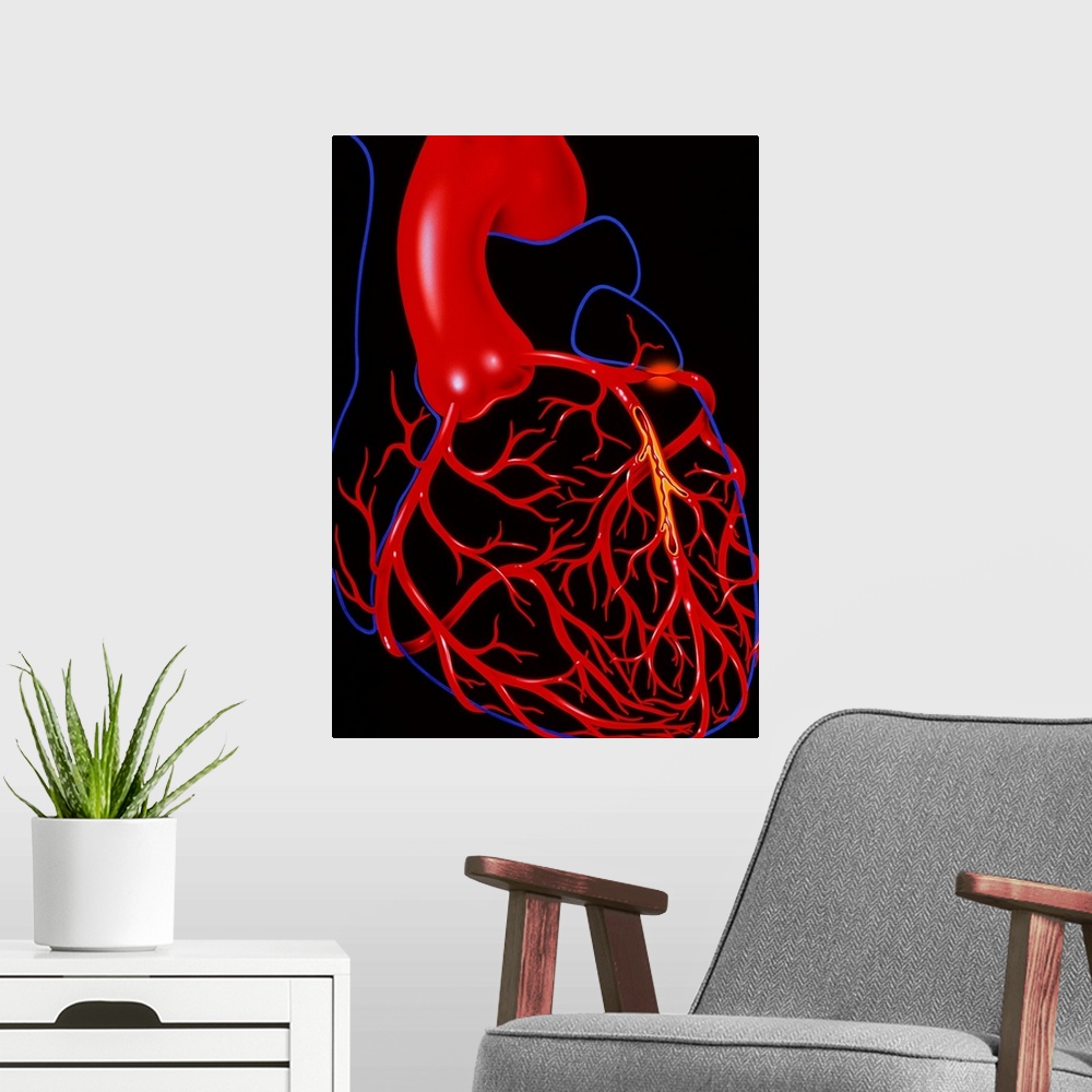 A modern room featuring Angina pectoris. Illustration of a heart diseased with the cardiac condition angina pectoris. The...
