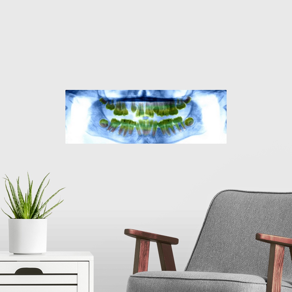 A modern room featuring Dental X-ray showing the teeth of a 13 year old girl.
