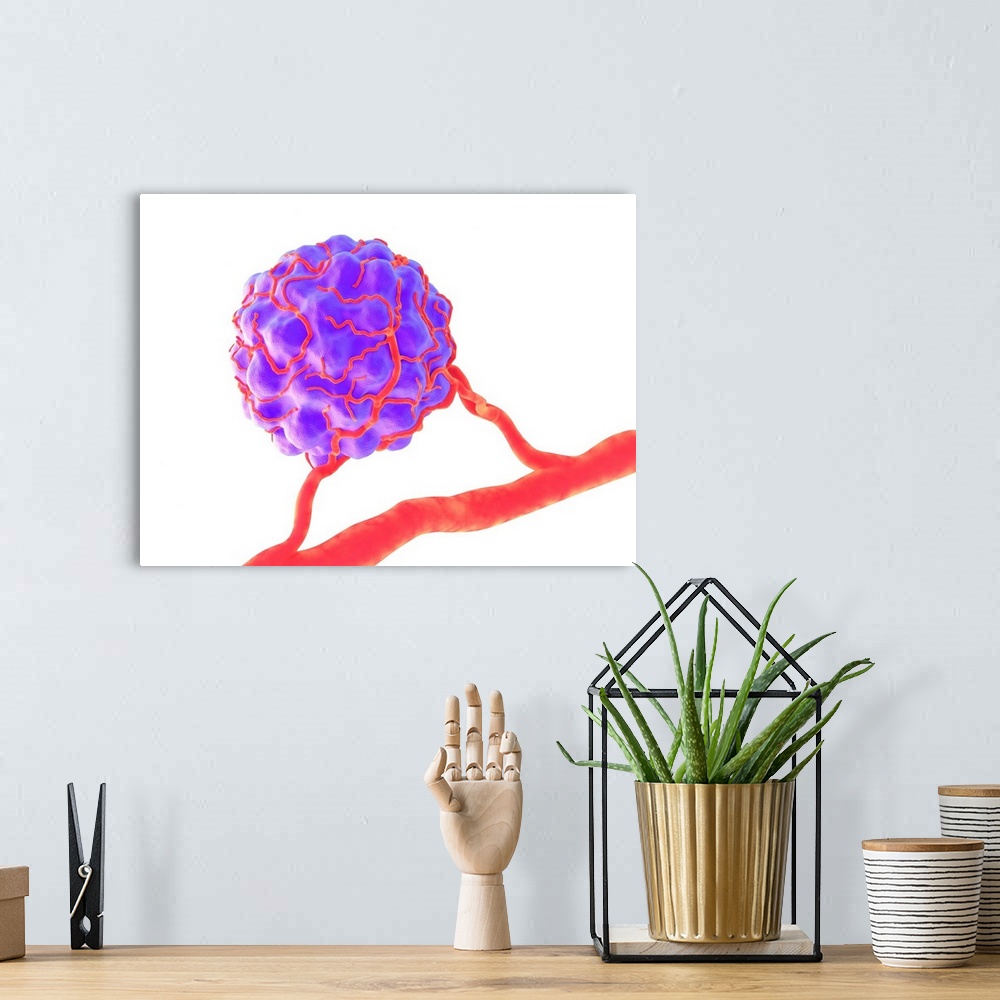 A bohemian room featuring Tumour, computer artwork. Tumours are caused by the uncontrolled growth of previously normal cell...