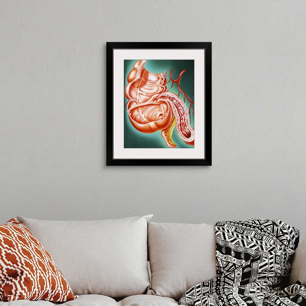 A bohemian room featuring Crohn's disease. Artwork of a section through part of the human digestive tract, showing the smal...