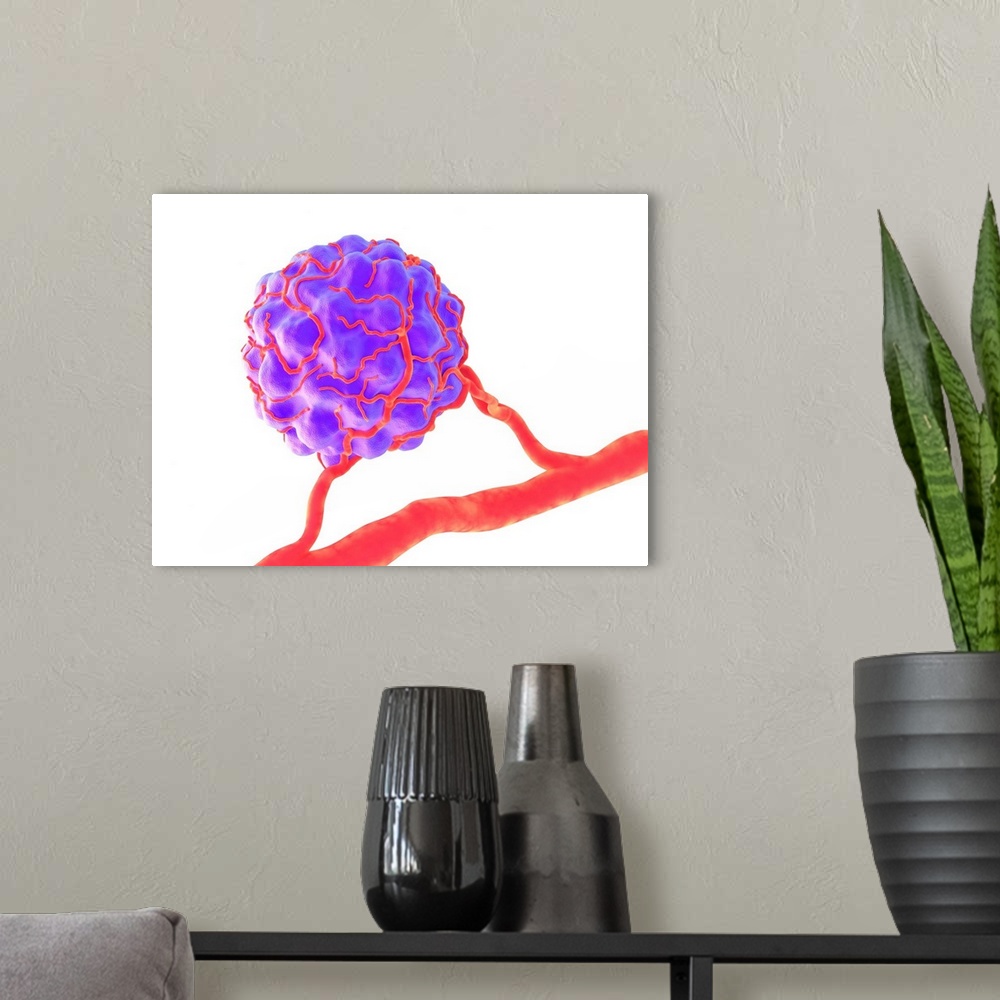 A modern room featuring Tumour, computer artwork. Tumours are caused by the uncontrolled growth of previously normal cell...