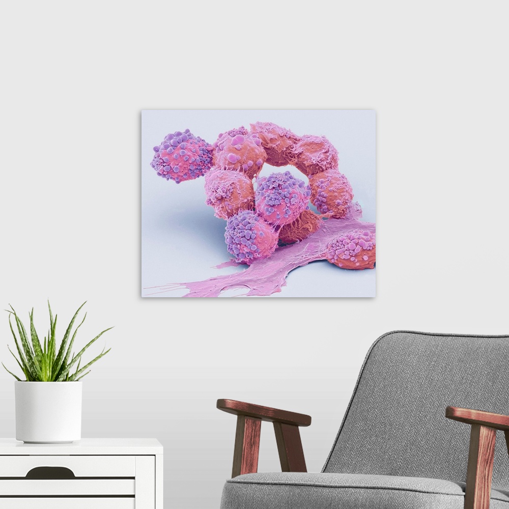 A modern room featuring Brain cancer cells. Coloured scanning electron micrograph (SEM) of cancerous cells from an oligod...