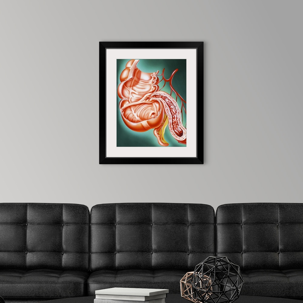 A modern room featuring Crohn's disease. Artwork of a section through part of the human digestive tract, showing the smal...