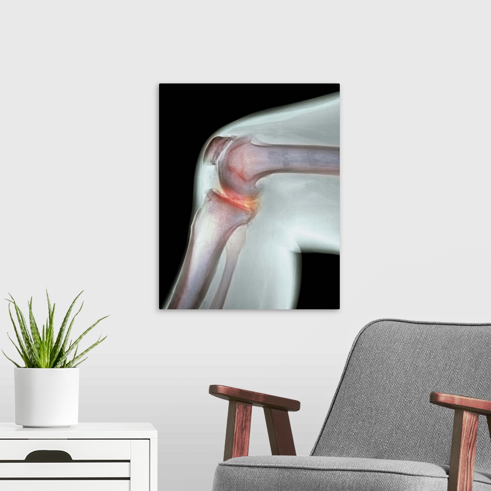 A modern room featuring Arthritis of the knee. Coloured X-ray the arthritic knee of a 37 year old man. The knee had previ...