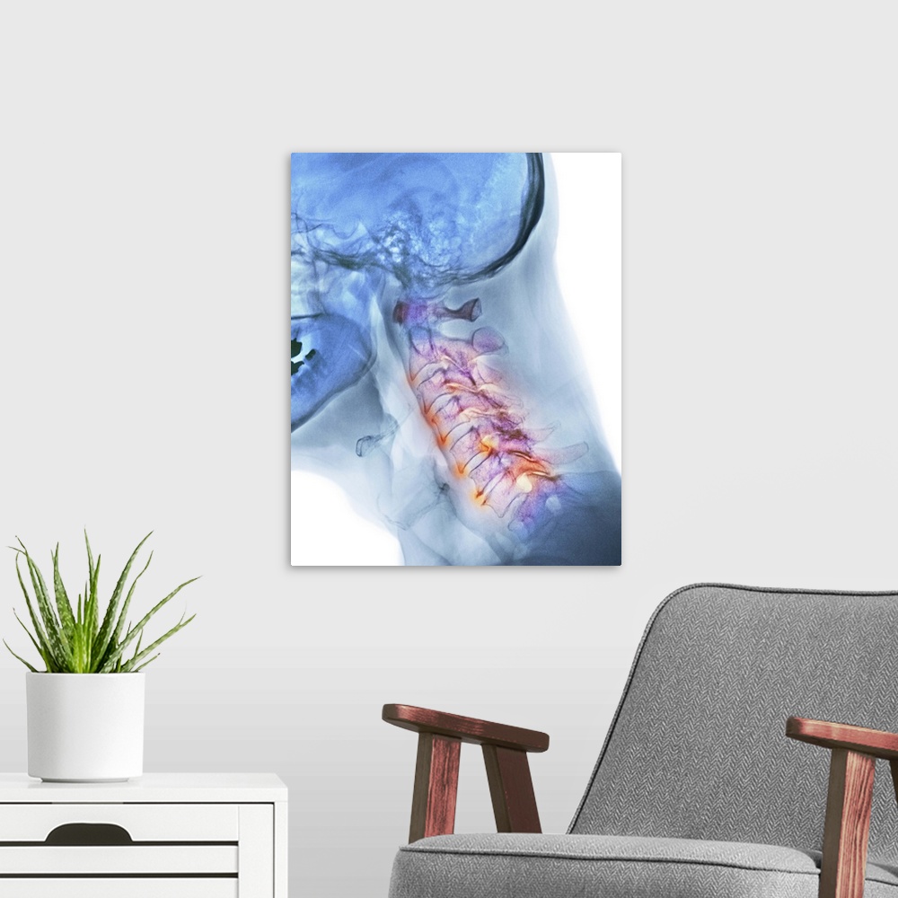 A modern room featuring Arthritis of the neck. Coloured X-ray of the arthritic cervical spine of a 70 year old man.