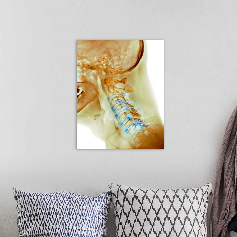 A bohemian room featuring Arthritis of the neck. Coloured X-ray of the arthritic cervical spine of a 70 year old man.