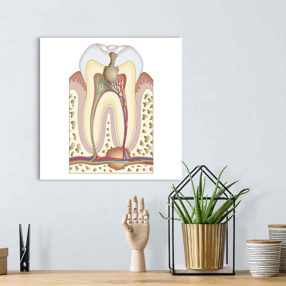 A bohemian room featuring Cross section biomedical illustration of pulp and root abscess in molar