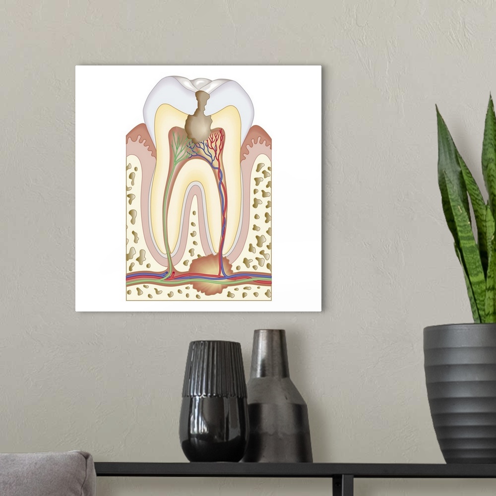 A modern room featuring Cross section biomedical illustration of pulp and root abscess in molar