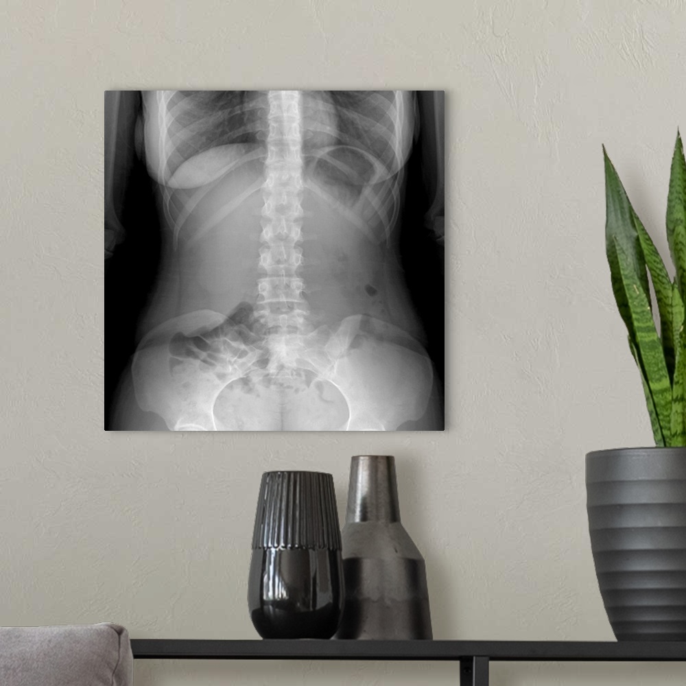 A modern room featuring Normal abdomen. X-ray of the abdomen of a 20 year old female.