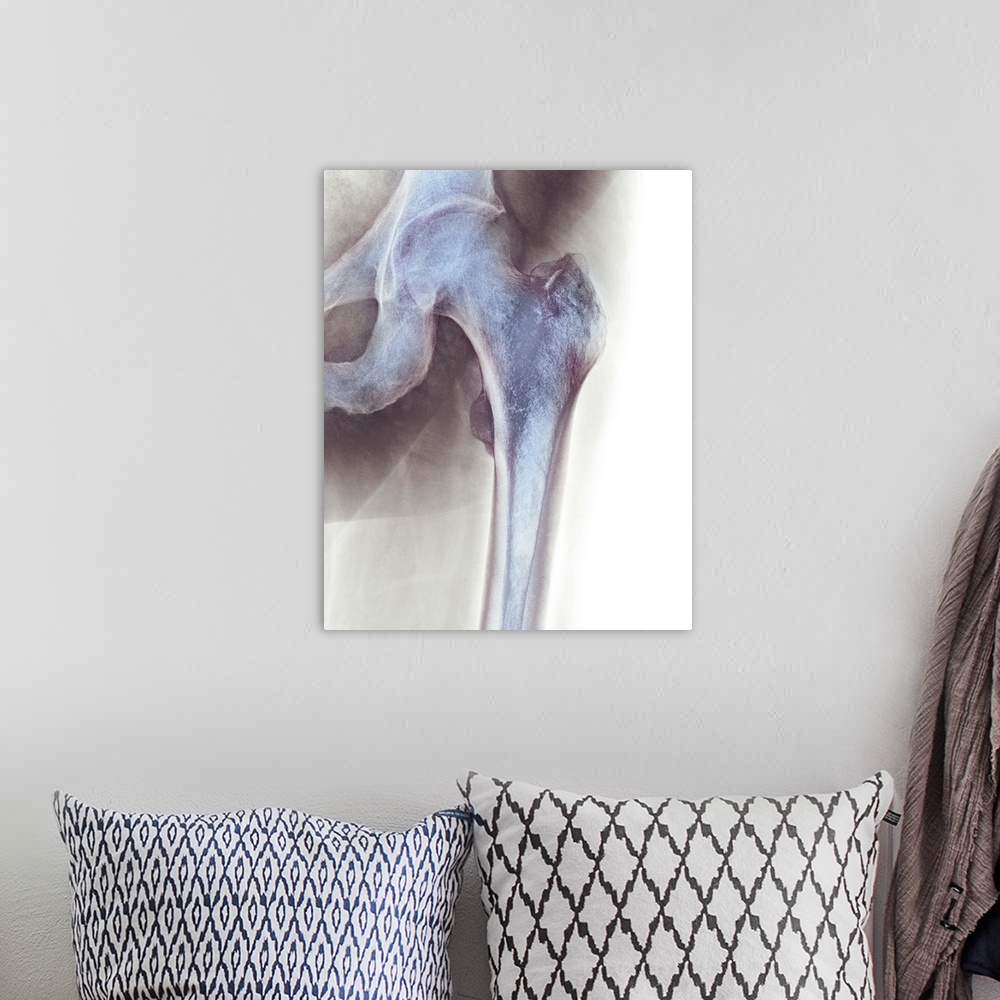 A bohemian room featuring Normal hip. Coloured X-ray of the hip of a 90 year old man.