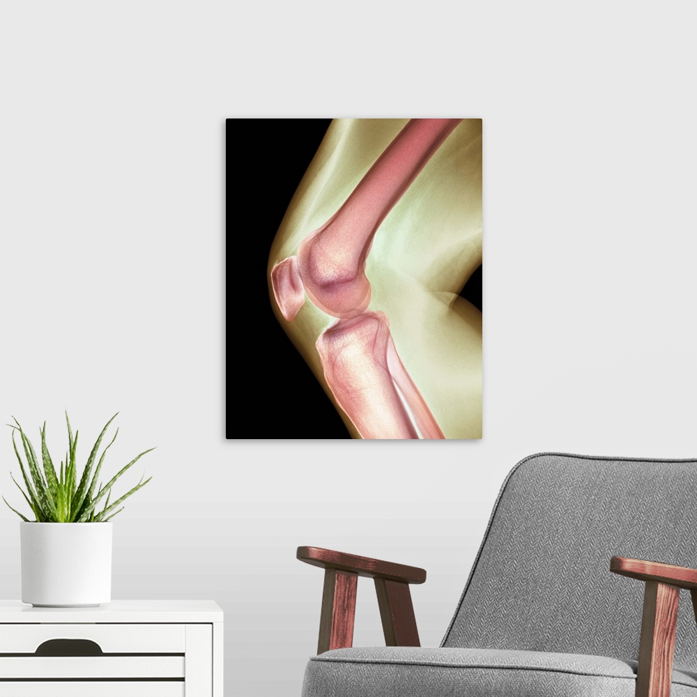 A modern room featuring Normal knee. Coloured X-ray of the knee of a 44 year old woman.