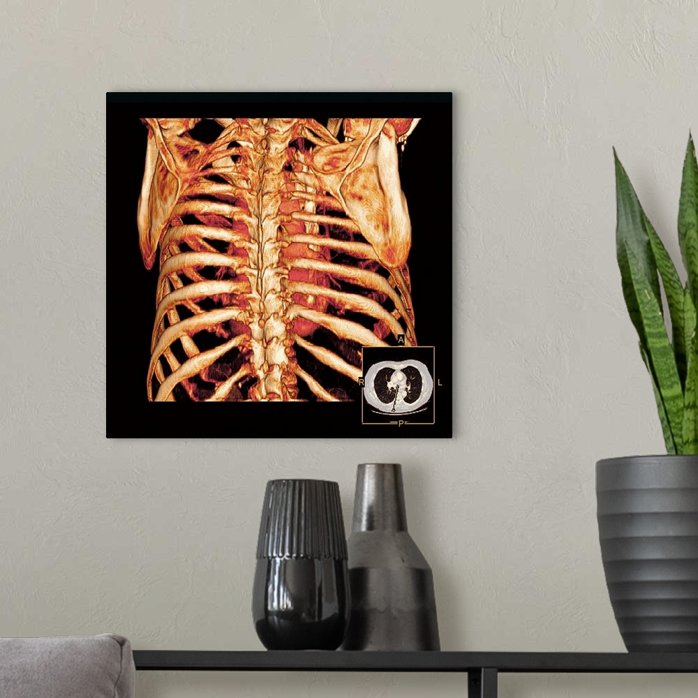 A modern room featuring Rib cage. Coloured three-dimensional computed tomography (CT) scan of a posterior view of a healt...
