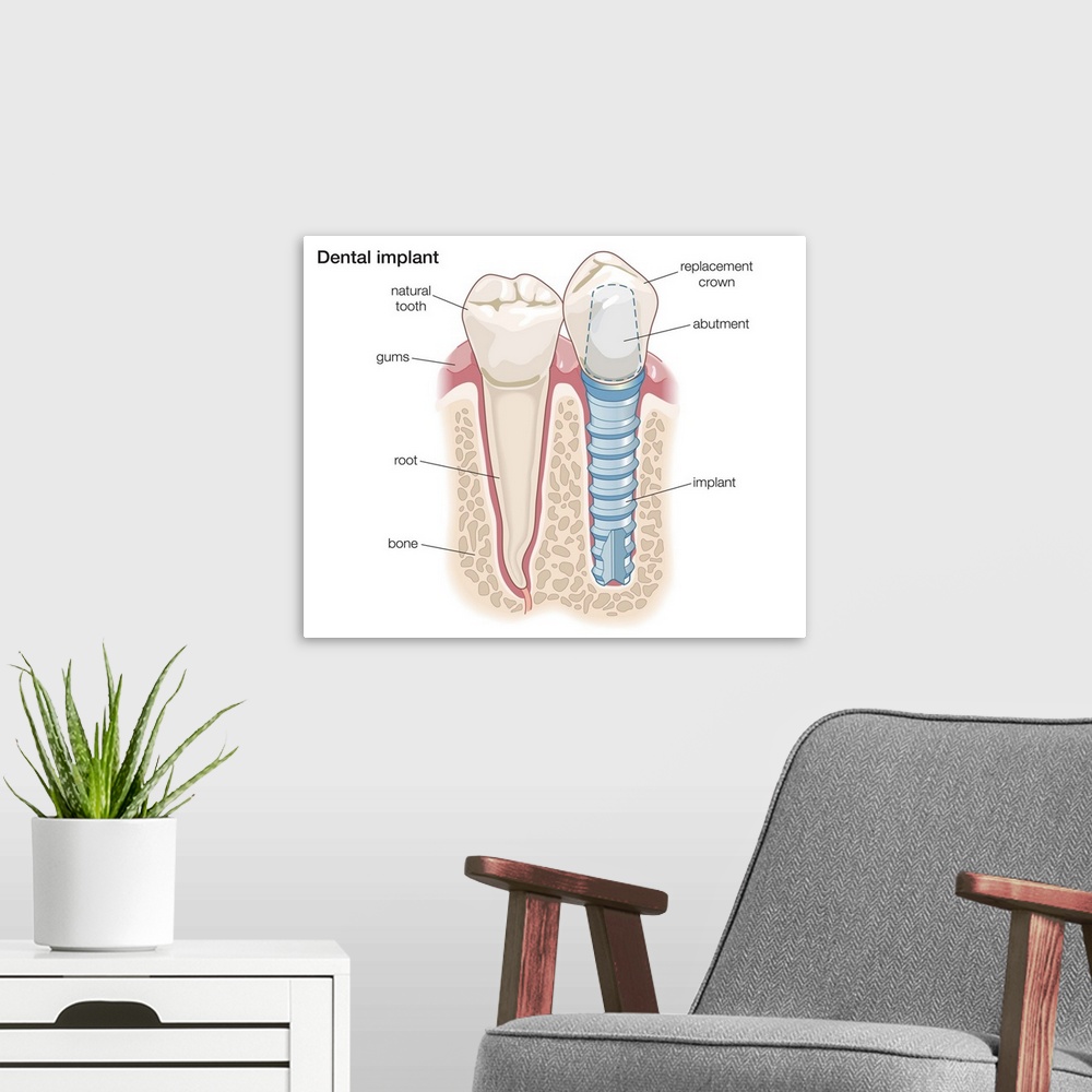 A modern room featuring Dental implant