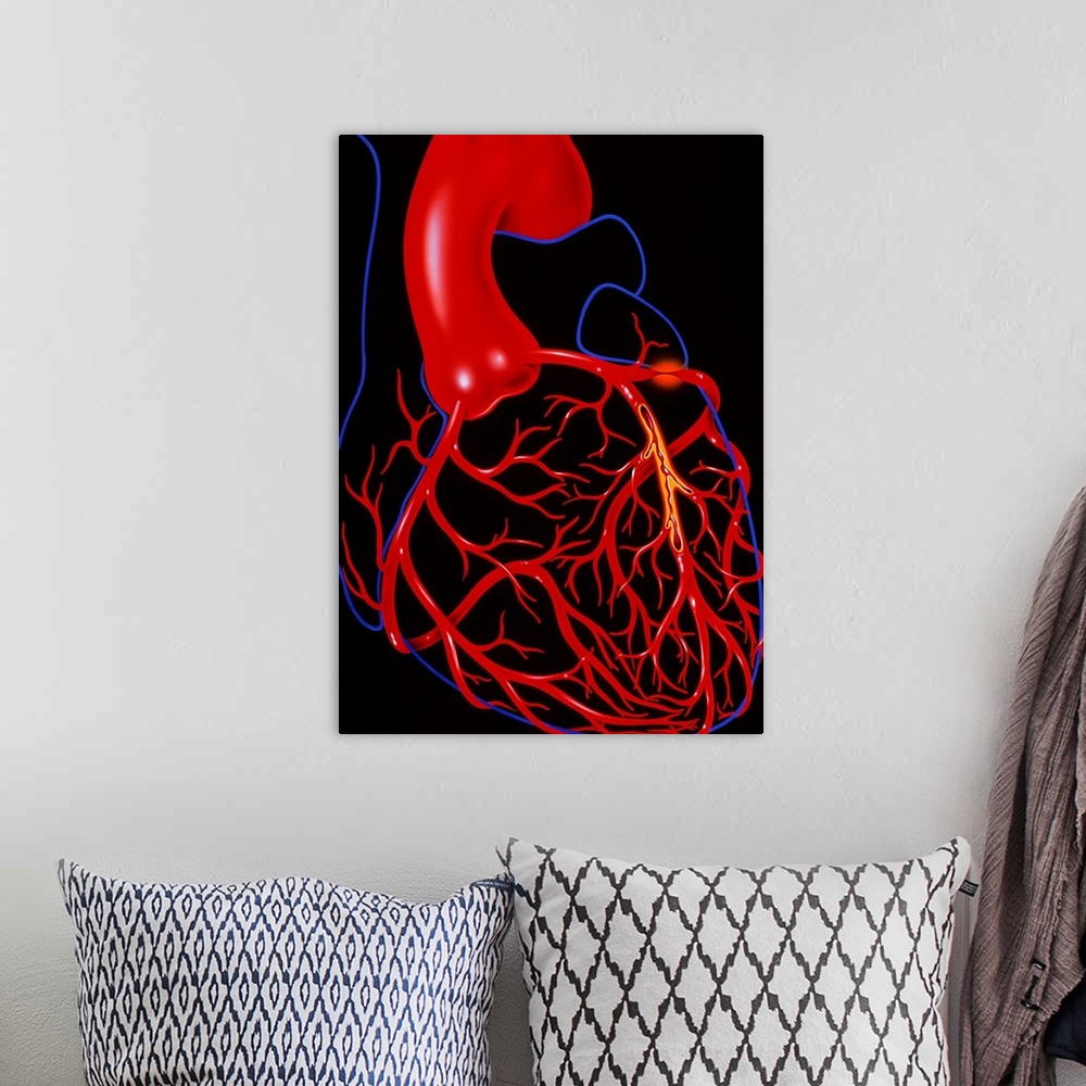 A bohemian room featuring Angina pectoris. Illustration of a heart diseased with the cardiac condition angina pectoris. The...