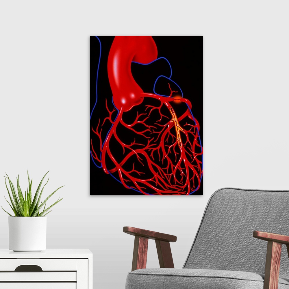 A modern room featuring Angina pectoris. Illustration of a heart diseased with the cardiac condition angina pectoris. The...