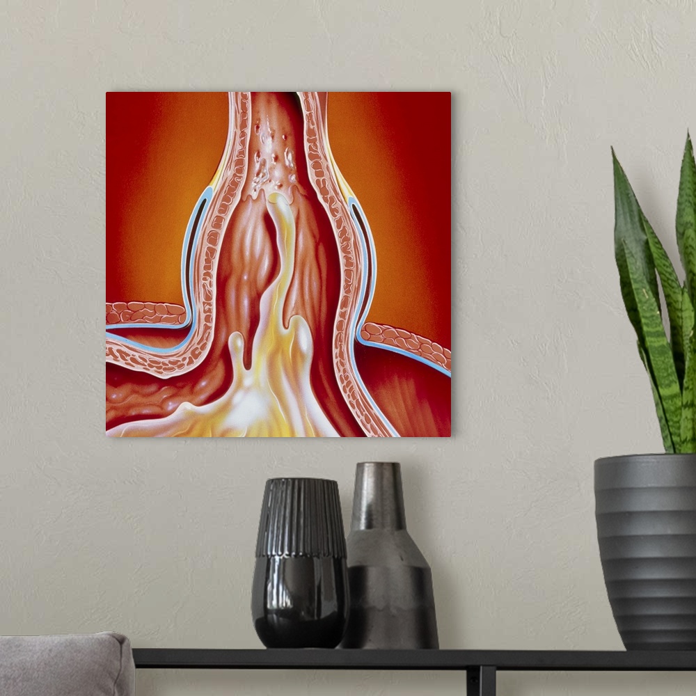 A modern room featuring Hiatus hernia. Illustration of a hiatus hernia, showing gastro-oesophageal reflux. Here, the junc...